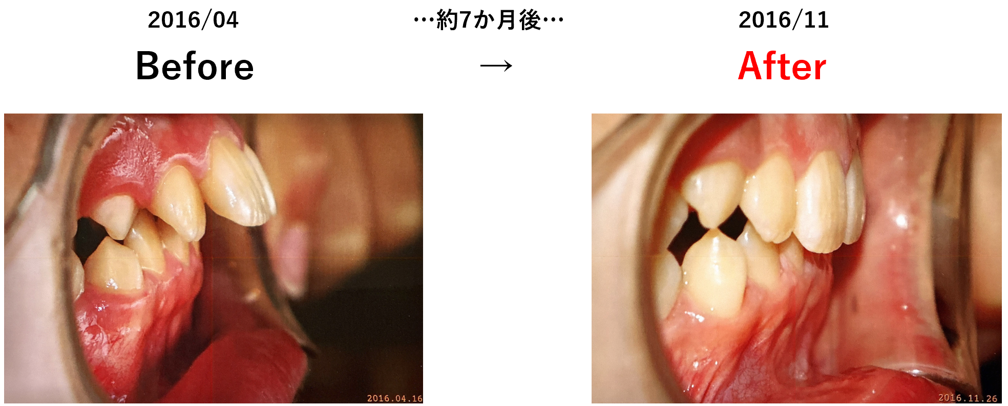 矯正治療の症例2：2015年9月から約1年11か月後の変化