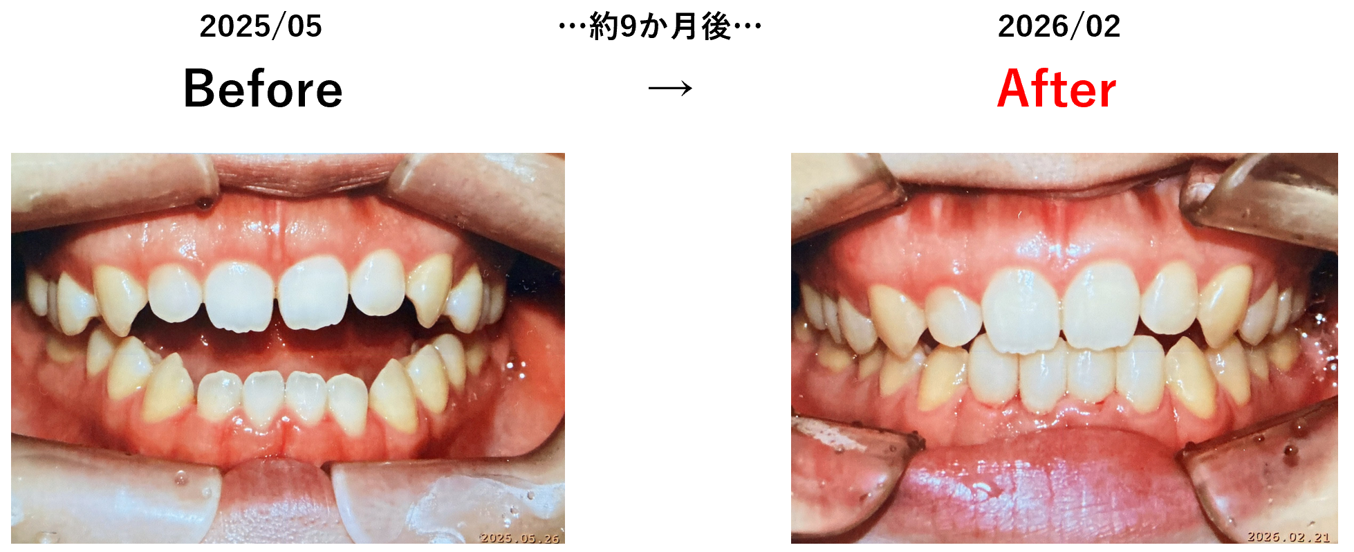 矯正治療の症例4：2025年5月から約9か月後の変化